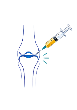 Corticosteroid knee injection illustration